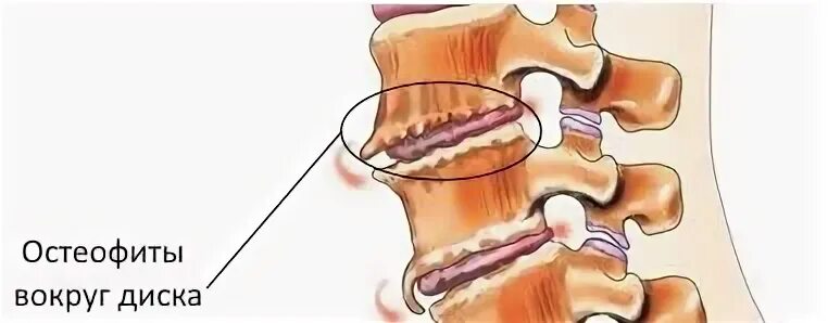 Остеофиты что это такое и как лечить. Остеофиты спондилез. Краевые костные разрастания остеофиты. Остеофиты шейного отдела позвоночника.