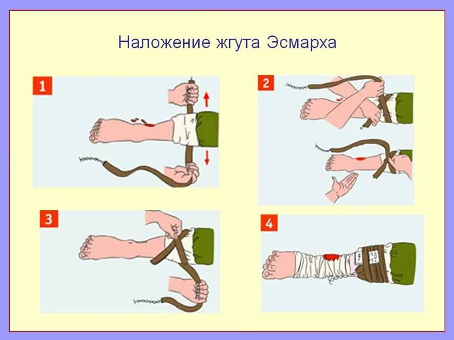 Технику наложения жгута на конечности. Правило наложение жгута Эсмарха. Наложение жгута для остановки артериального кровотечения. Наложение жгута Эсмарха при кровотечениях. Кровотечение наложение кровоостанавливающего жгута.
