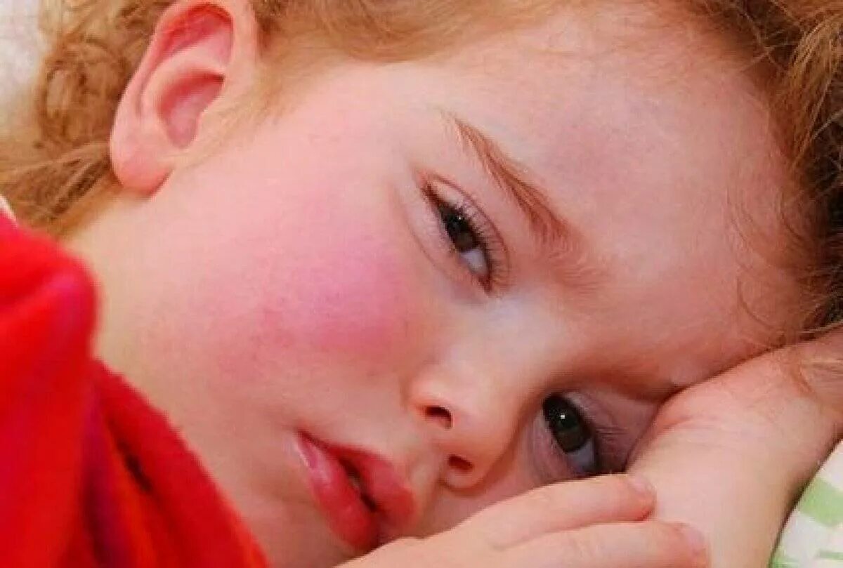 Ребенок 4 года высокая температура. Лихорадочные состояния у детей. Красная лихорадка. Гипертермия кожи у детей.