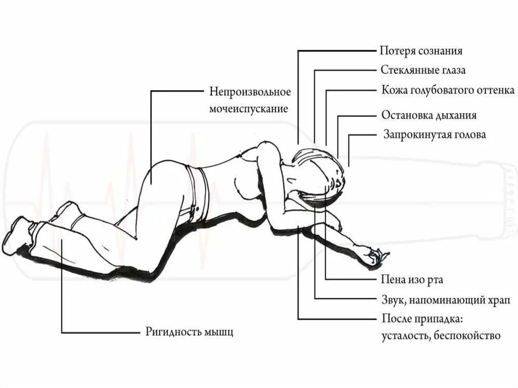 Проявление эпилепсии. Эпилепсия проявления симптомы. Эпилептические судороги симптомы. Признаки эпилептического припадк. Признаки эпелидического припадок.