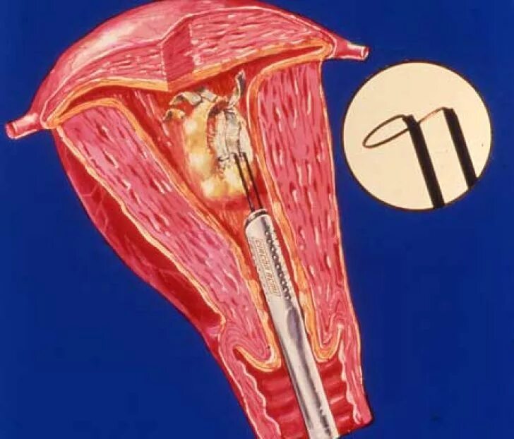 Выскабливание как проводится. Гистерорезектоскопия полипа эндометрия. Миомэктомия матки гистероскопическая. Выскабливание слизистой оболочки матки. Операция выскабливания эндометрия.