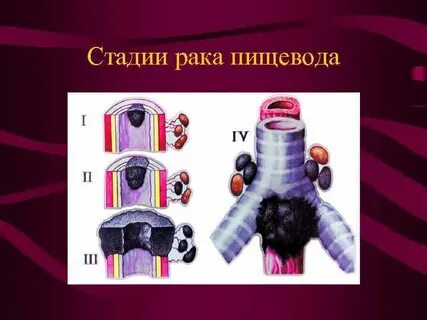 Стадии рака пищевода