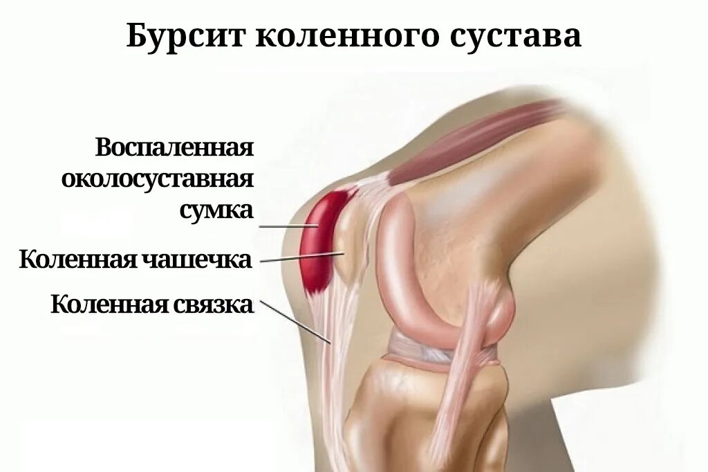 Кровотечение в коленный сустав. Инфрапателлярный бурсит. Супрапателлярный синовит (супрапателлярный бурсит). Супрапателлярный бурсит коленного сустава на кт. Супрапателлярный бурсит рентген.