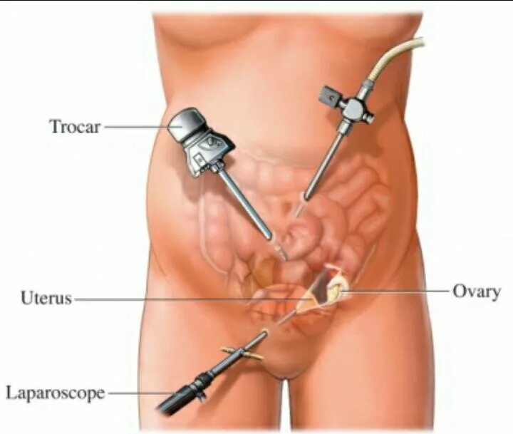 Анализы перед лапароскопией. Лапароскопическая миомэктомия. Лапароскопия кисты яичника шрамы. Лапароскопия эндометриоидной кисты. Лапароскопия миомэктомия.