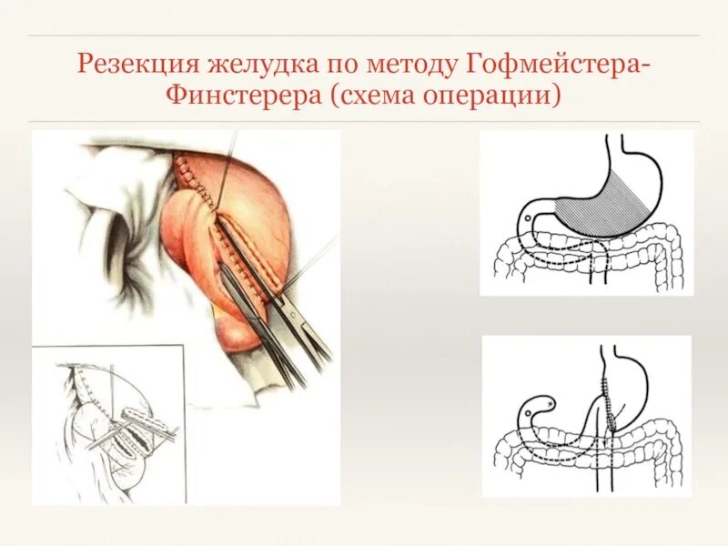 Резекция желудка по гофмейстеру. Резекция по гофмейстеру-финстереру. резекция желудка по гофмейстеру-финстереру схема. резекция желудка по бальфуру схема. способы резекции желудка.