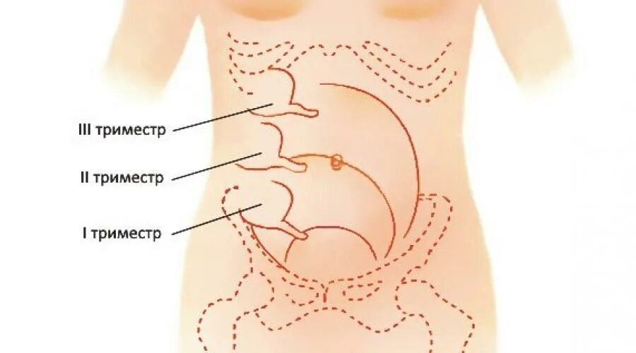 Болит живот при беременности 36. Расположение аппендикса при беременности. Аппендицит при беременности 3 триместр. Расположения червеобразного отростка при беременности. Болит аппендицит при беременности.