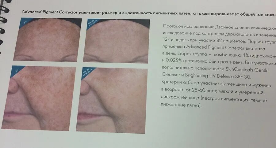 Как быстро убрать пигментные пятна на лице. Возрастные пигментные пятна. возрастная пигментация на лице. старческие пигментные пятна. образование пигментных пятен на коже.