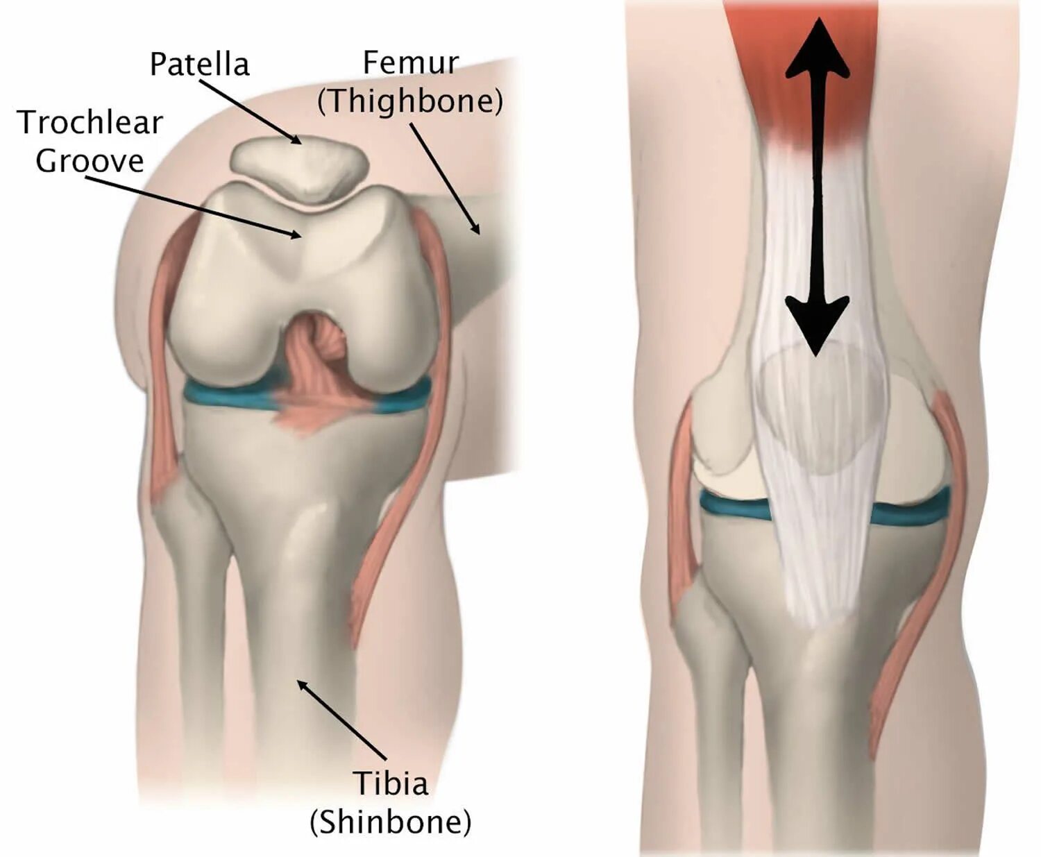 Надколенник коленного сустава анатомия. Надколенник Patella. Хондромаляция надколенника коленного сустава. Хондромаляция надколенника 4 степени. Хондромаляция медиальных мыщелков