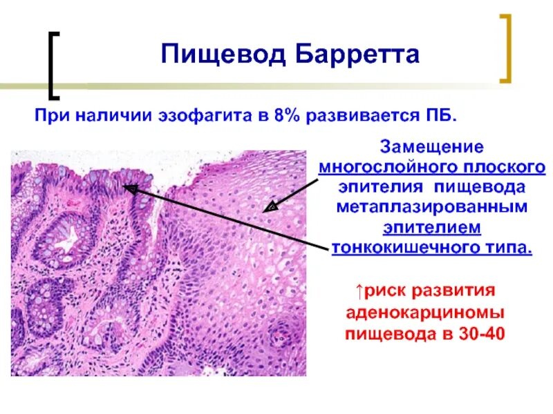 Группы клеток метаплазированного. Пищевод Барретта метаплазия эпителия. Пищевод Барретта гистология. Пищевод Барретта микропрепарат. Пищевода баре ТТА гистология.