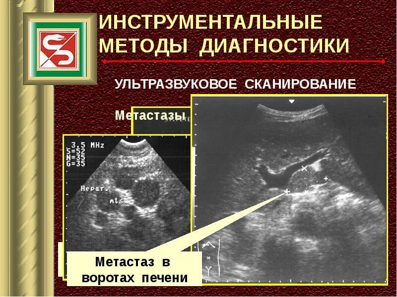 Метастазы в печени прогноз срока жизни. Метастатические опухоли печени. печень пораженная метастазами. метастазы в воротах печени. метастазы в печени печени.