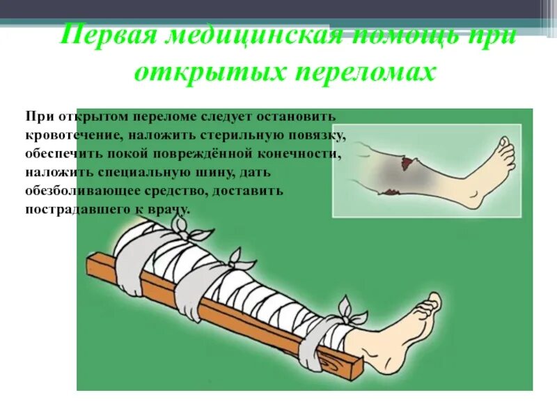 При открытом переломе перед наложением шины. Первая медицинская помощь при открытом переломе бедренной кости. Повязка при открытом переломе. Фиксация при открытом переломе.