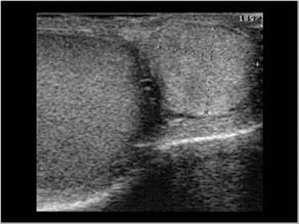 Перекрут яичка УЗИ картина. Перекрут гидатиды придатка яичка. Перекрут левого яичка УЗИ. Киста придатка левого яичка Uzi.