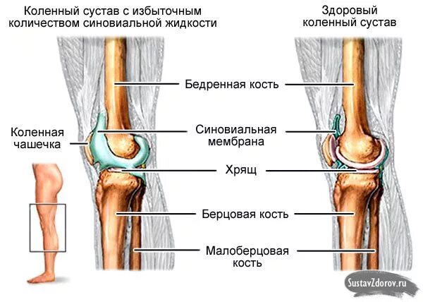 Коленный сустав сайт. Синовиальная жидкость выпот в коленном. Внутрисуставная жидкость коленного сустава. ,Синовит синовита коленного сустава. Количество синовиальной жидкости в коленном суставе.