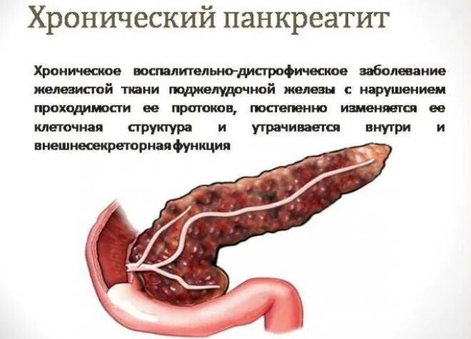Заболев поджелудочной железы. Болезнь хронический панкреатит поджелудочной железы. панкреатит это хроническое заболевание. хронический панкреатин симптомы. подострый панкреатит симптомы.