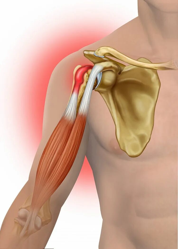 Эффективное лечение плечевого сустава. Тендинит сухожилия бицепса плечевого сустава. Тендинит сухожилия двуглавой мышцы плеча. Тендинит — воспаление сухожилий плечевого сустава;. Тендинит сухожилия бицепса.