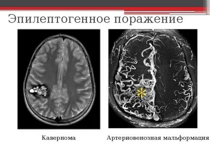 Кавернозная венозная мальформация