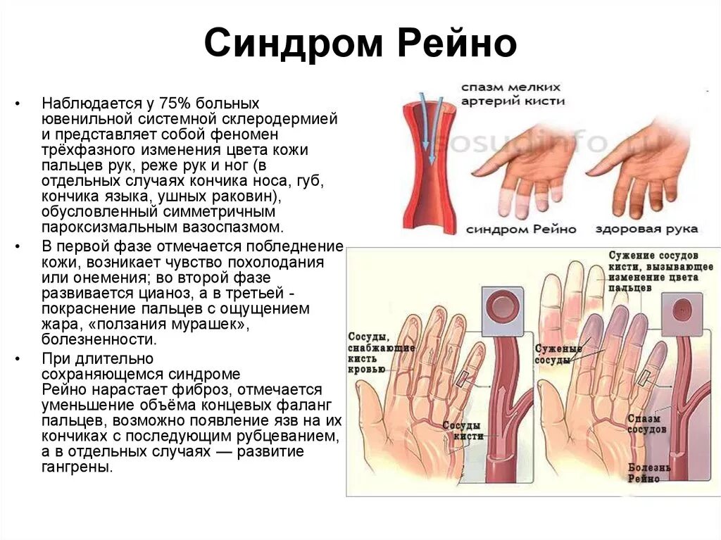 Симптомы, характерные для болезни Рейно:. Синдром Рейно при системной склеродермии. Синдром Рейно УЗИ сосудов. Спазм периферических сосудов синдром Рейно. Изменение формы руки