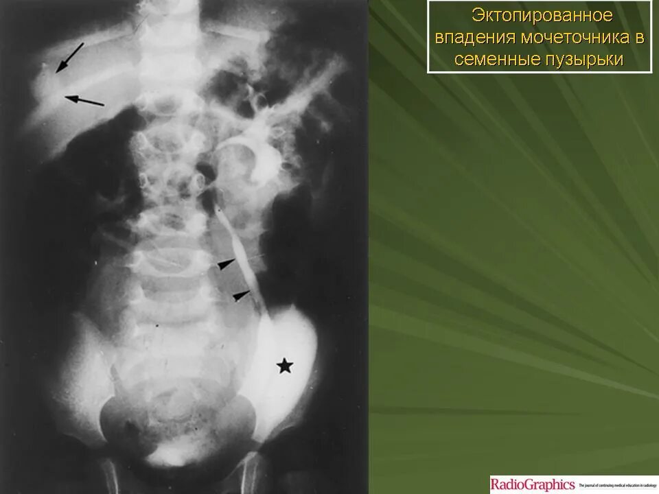 Мочеточник слева. Уровазальная аномалия мочеточника. Мочеточник рентген анатомия. Строение мочеточника у женщин.