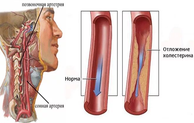 Сужение шейных сосудов. Атеросклероз бляшка сонной артерии. Атеросклероз сосудов шеи сонных артерий. Обтюрация сосудов сонных артерий.