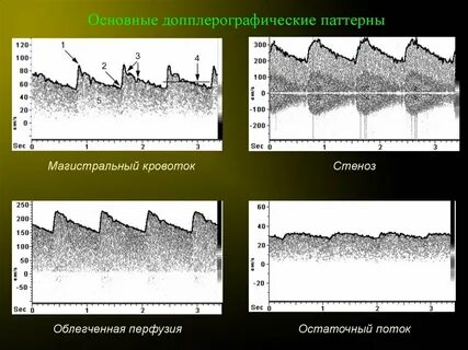Магистральный кровоток