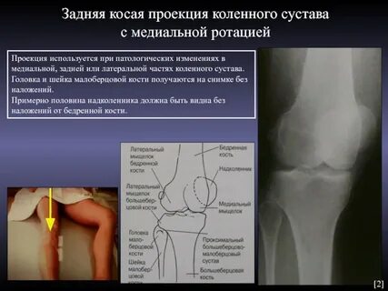 Проекции коленного сустава