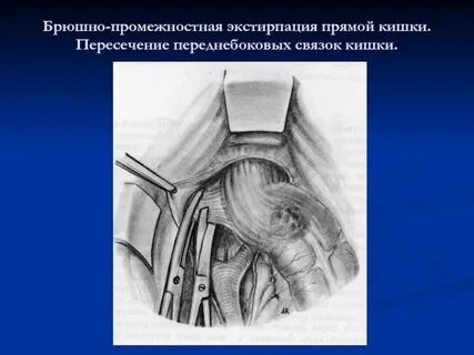 Экстирпация прямой