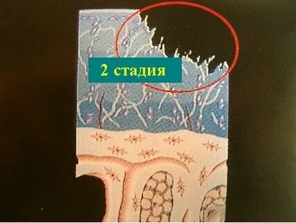 Хондромаляция 2 степени