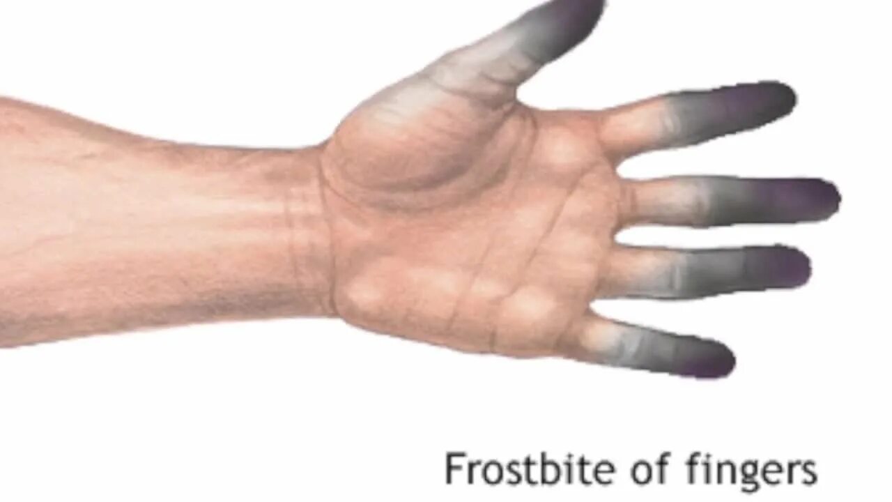 Cyanosis - Wikipedia