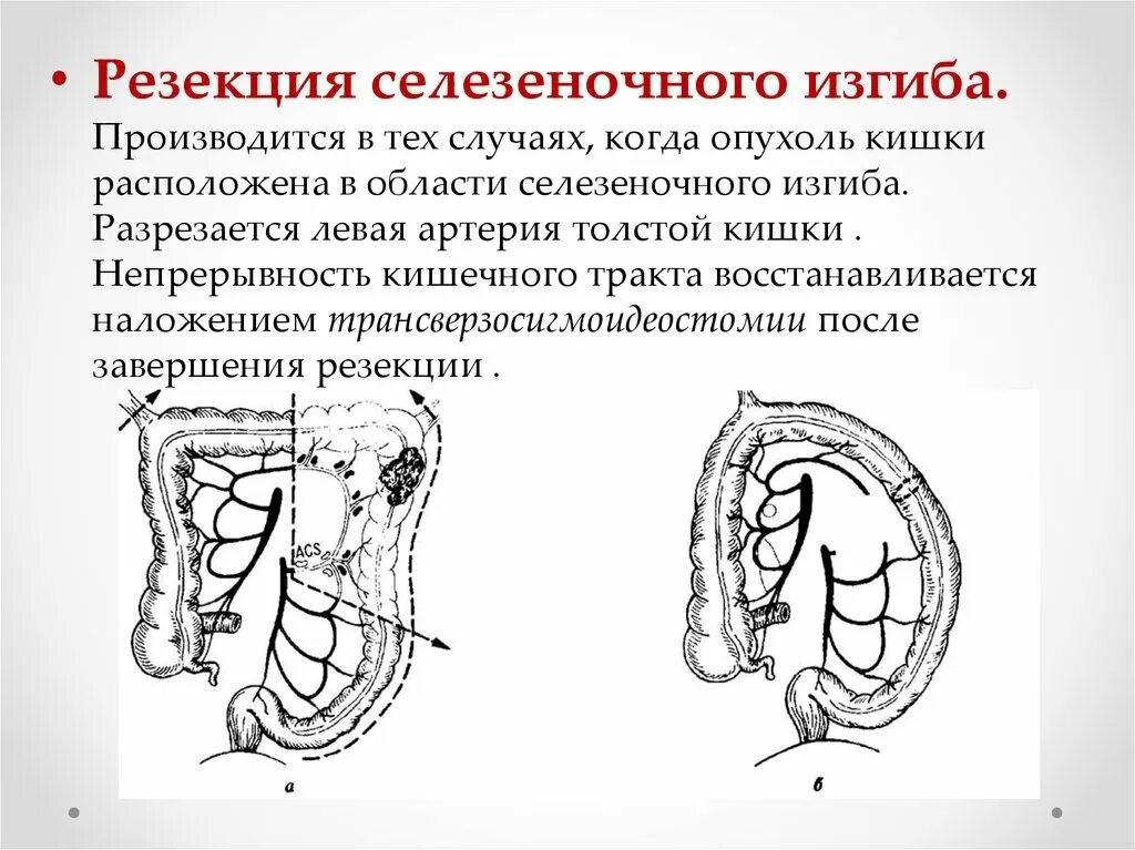 Опухоль селезеночного угла ободочной кишки. Опухоль печеночного изгиба ободочной кишки. Селезеночный изгиб ободочной кишки. Селезеночная кривизна ободочной кишки.