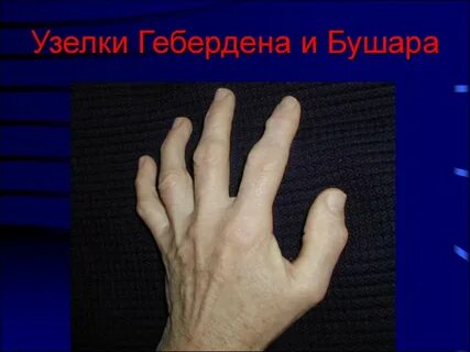Лечение узелков