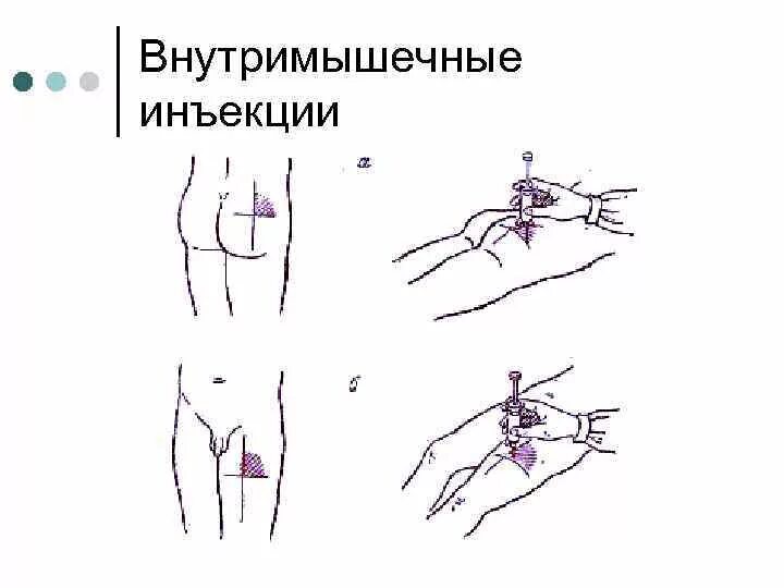 Проведение внутримышечной инъекции алгоритм. Внутримышечная инъекция в ягодицу алгоритм. схема введения внутримышечной инъекции. алгоритм техники выполнения внутримышечной инъекции. схема введения внутримышечной инъекции в бедро.