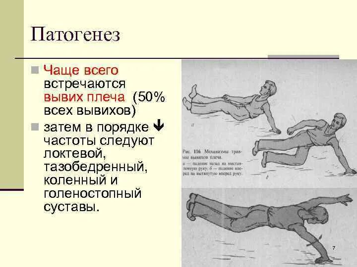 Вывих или растяжение плеча. Этиология вывихов.