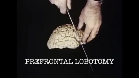 Лоботомия до и после