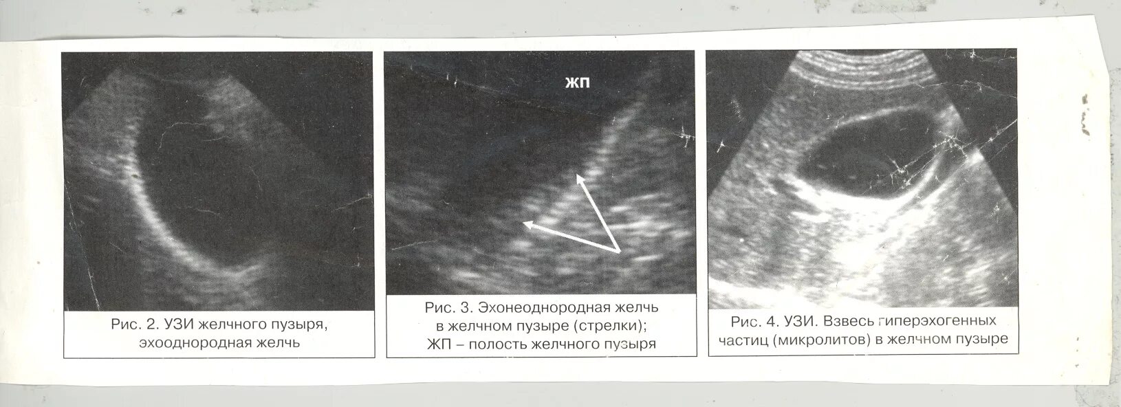 Эхопризнаки желчного пузыря. УЗИ желчного пузыря и желчевыводящих путей. Дискинезия желчевыводящих путей УЗИ. Замазкообразная желчь на УЗИ. Дискинезия желчного пузыря на УЗИ.