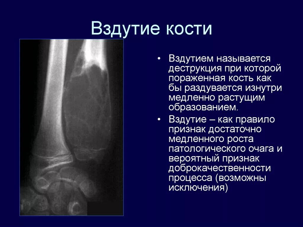 Какие бывают заболевания костей. Вздутие костей на рентгене. симптом вздутия кости на рентгене.