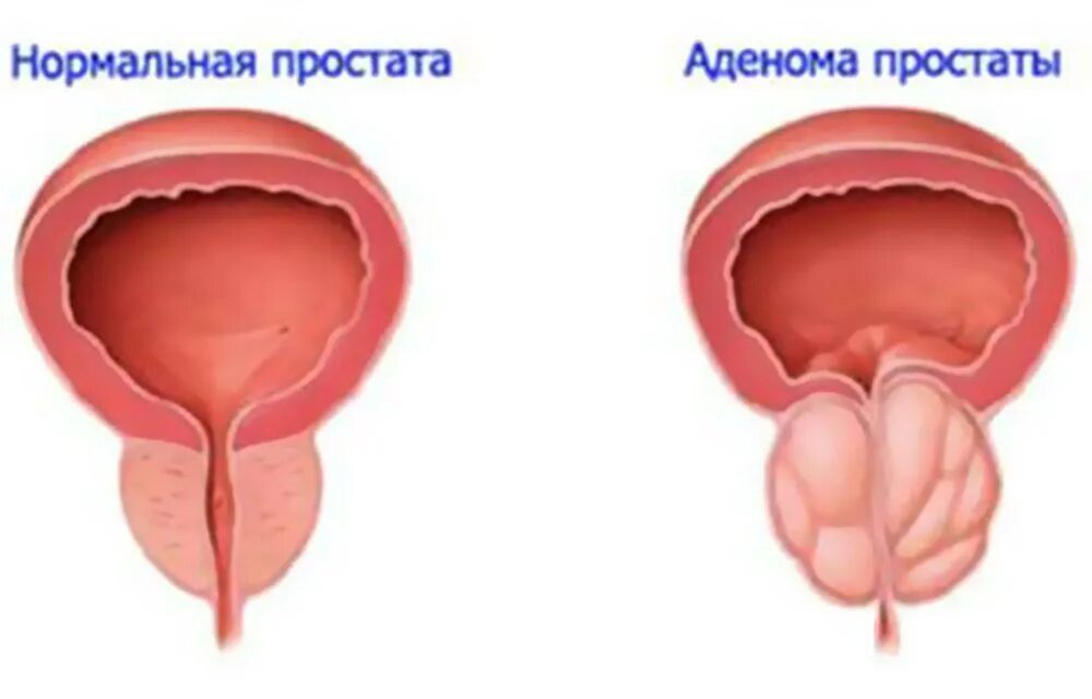 Воспалился простатит. Аденома предстательной железы. Простата аденома простаты.