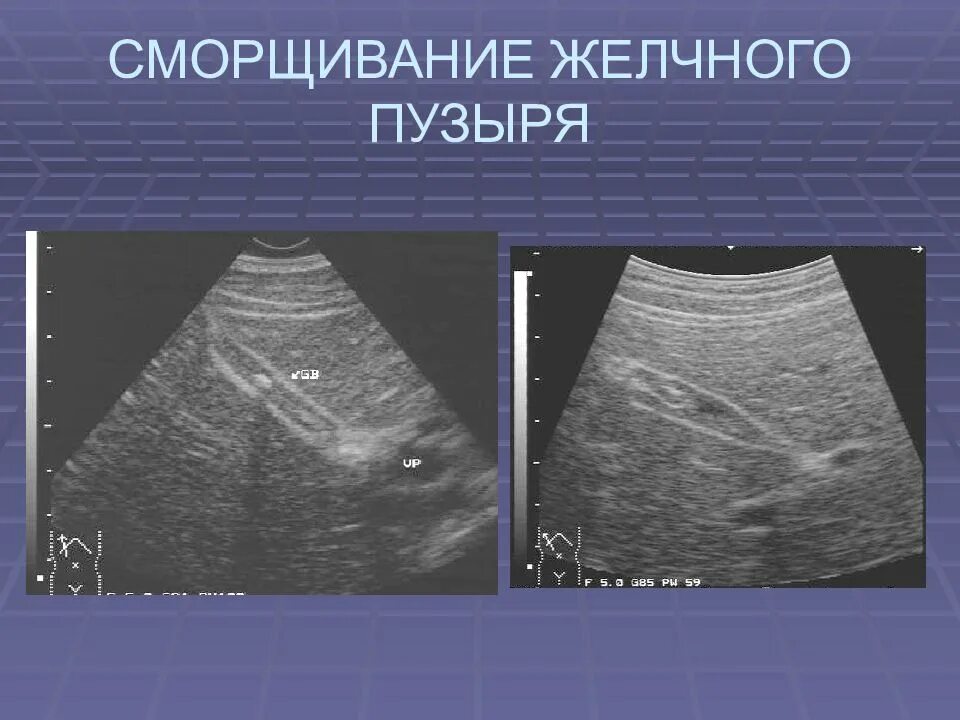 Уменьшенный желчный пузырь. Выключенный желчный пузырь УЗИ. Сморщенный желчный пузырь на УЗИ. Отключенный желчный пузырь на УЗИ. УЗИ признаки отключенного желчного пузыря.