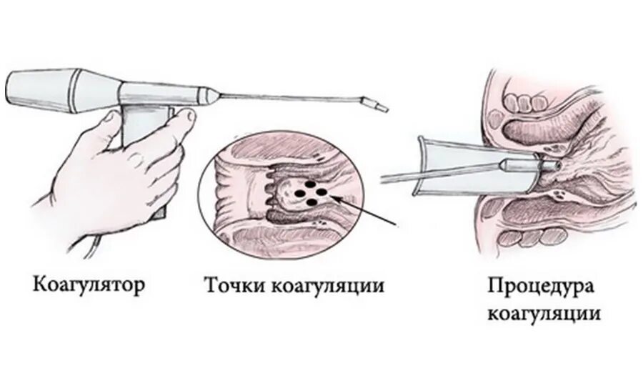 Лазерная коагуляция в хирургии. Инфракрасная фотокоагуляция геморроя. Фотокоагулятор ректальный. Иссечение геморроидальных бахромок. Инфракрасная коагуляция геморроидальных узлов.