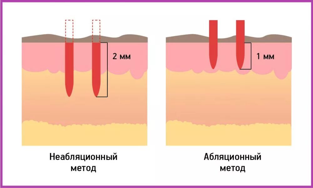 Лазерная шлифовка схема воздействия. Глубина лазера co2 кожи. Абляционные и неабляционные лазеры.