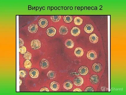 Простой герпес впг