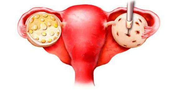 Яичники у женщин цена. Поликистоз яичников лапароскопия. Каутеризация (Дриллинг) яичников. Синдром поликистозных яичников операция.