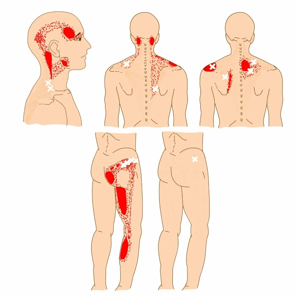 Болевые триггерные точки схема массажа. Локализация боли в груди. Точки травм и боли на теле. Локализация боли в сердце. Болит спина.