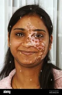 Vitiligo skin disorder. 