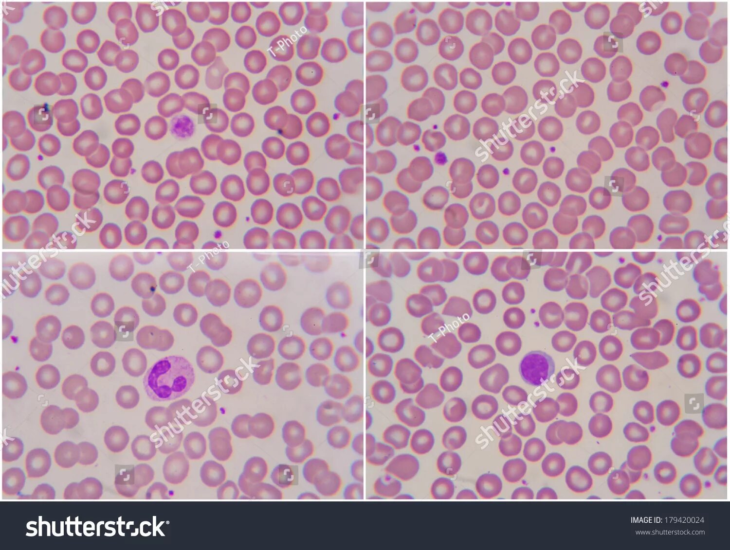 Blood Smear Under Microscope Present Neutrophils and Red Blood Cells. Photo Micr