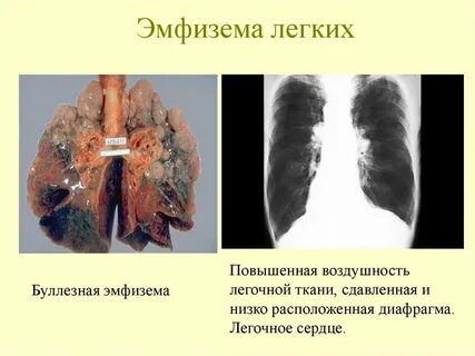 Буллы в легких что это такое