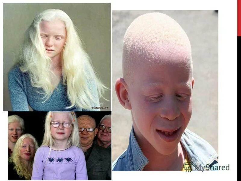 Наследственная болезнь альбинизм. Глазокожный альбинизм.