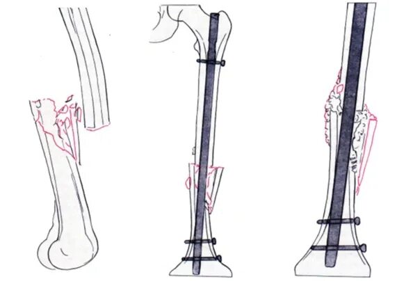 Остеосинтез перелома бедренной кости. Остеосинтез большой берцовой кости штифтом реабилитация. Перелом шейки бедра остеосинтез. Реабилитация после перелома бедренной кости после операции