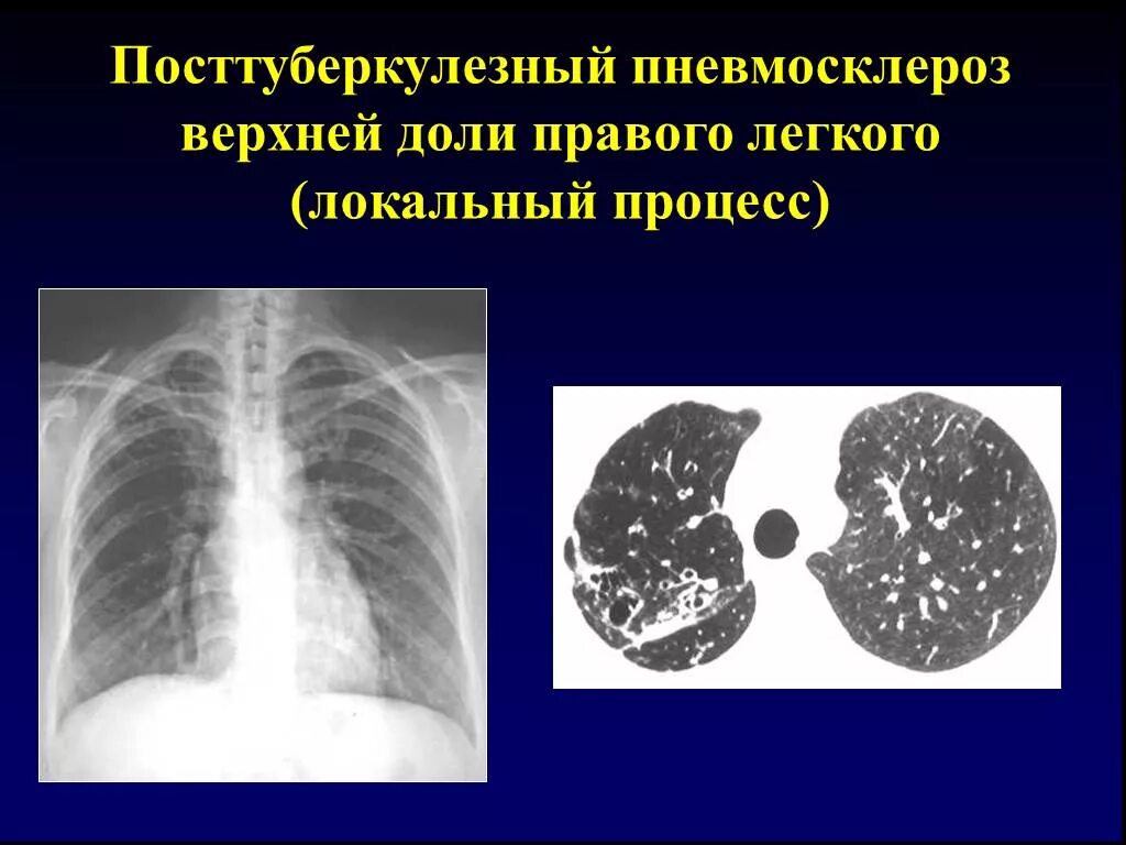 Изменения в верхней доле легкого. Идиопатический пневмофиброз. Постпневмонический пневмофиброз на рентгене. Посттуберкулёзный пневмосклероз. Пневмосклероз легких кт.