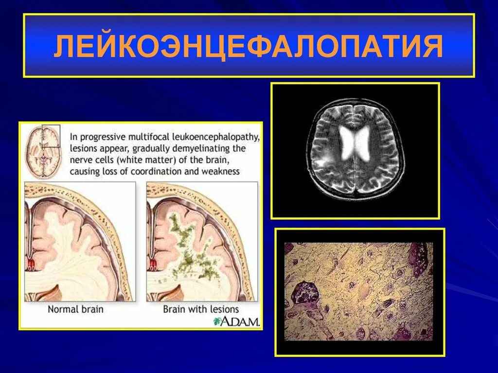 Многоочаговые поражения головного. Лейкоэнцефалопатия головного мозга сосудистого генеза. Лейкоэнцефалопатия головного симптомы. Мультифокальная лейкоэнцефалопатия. Прогрессирующая многоочаговая лейкоэнцефалопатия.