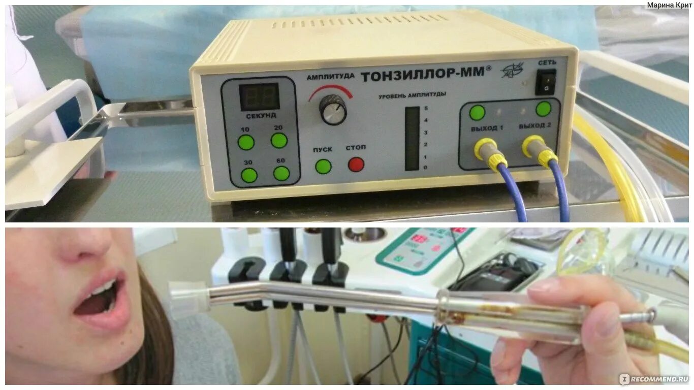 Аппарат Тонзиллор мм. Тонзиллор аппарат для промывания. Лечение на аппарате тонзиллор